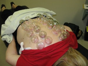 Full Back Cupping